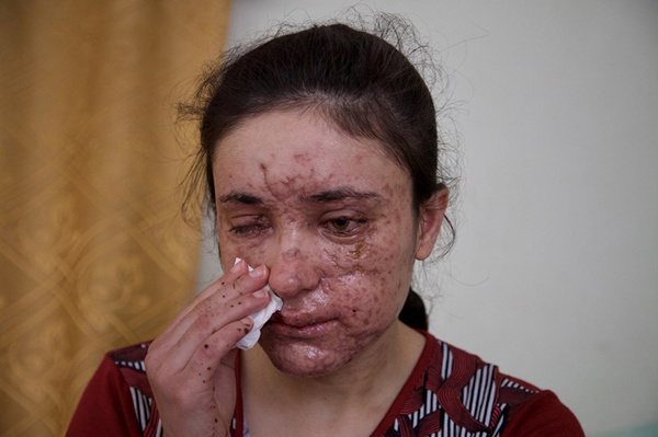 Lamiya Aji Bashar ha perso l'occhio destro e il suo viso è segnato dalla pelle corrosa della mina esplosa mentre scappava