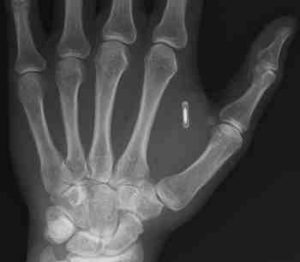 Microchip nella mano